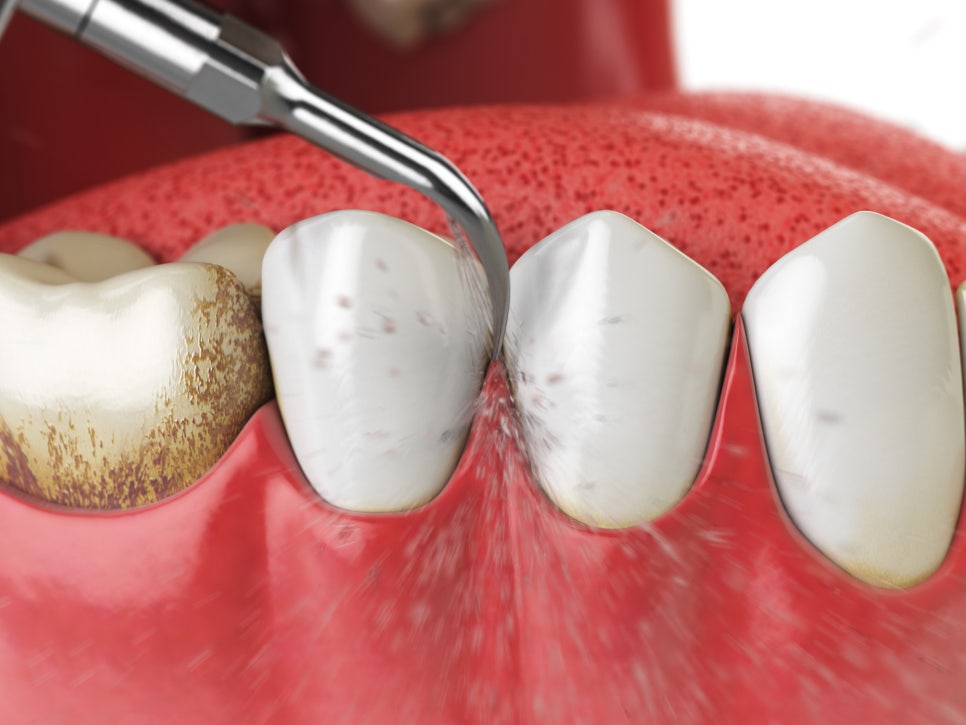 정자역 드라마치과병원, 잇몸통증의 원인 치은염!