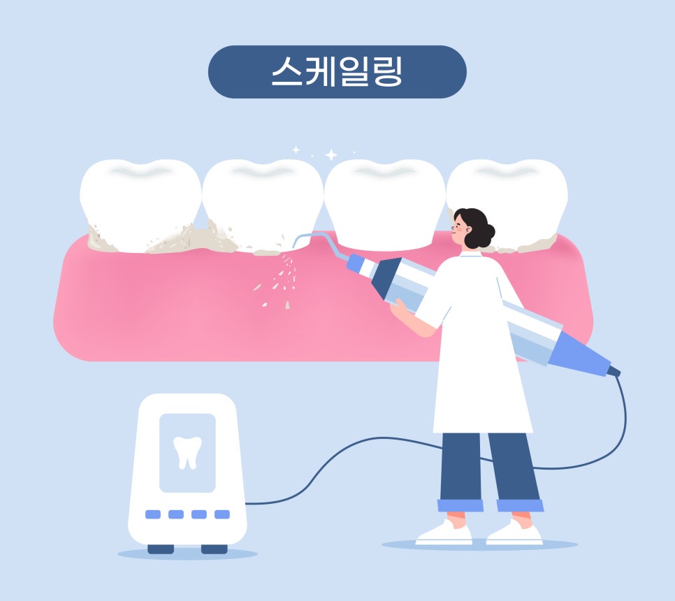 정자역 치태, 치석 제거엔? 스케일링