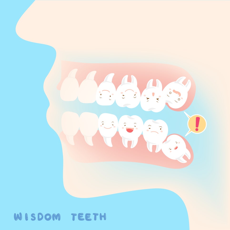 정자동치과, 사랑니 발치 후 주의사항~