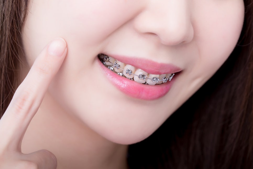 정자동 치열 개선으로 심미적인 개선까지! 치아교정