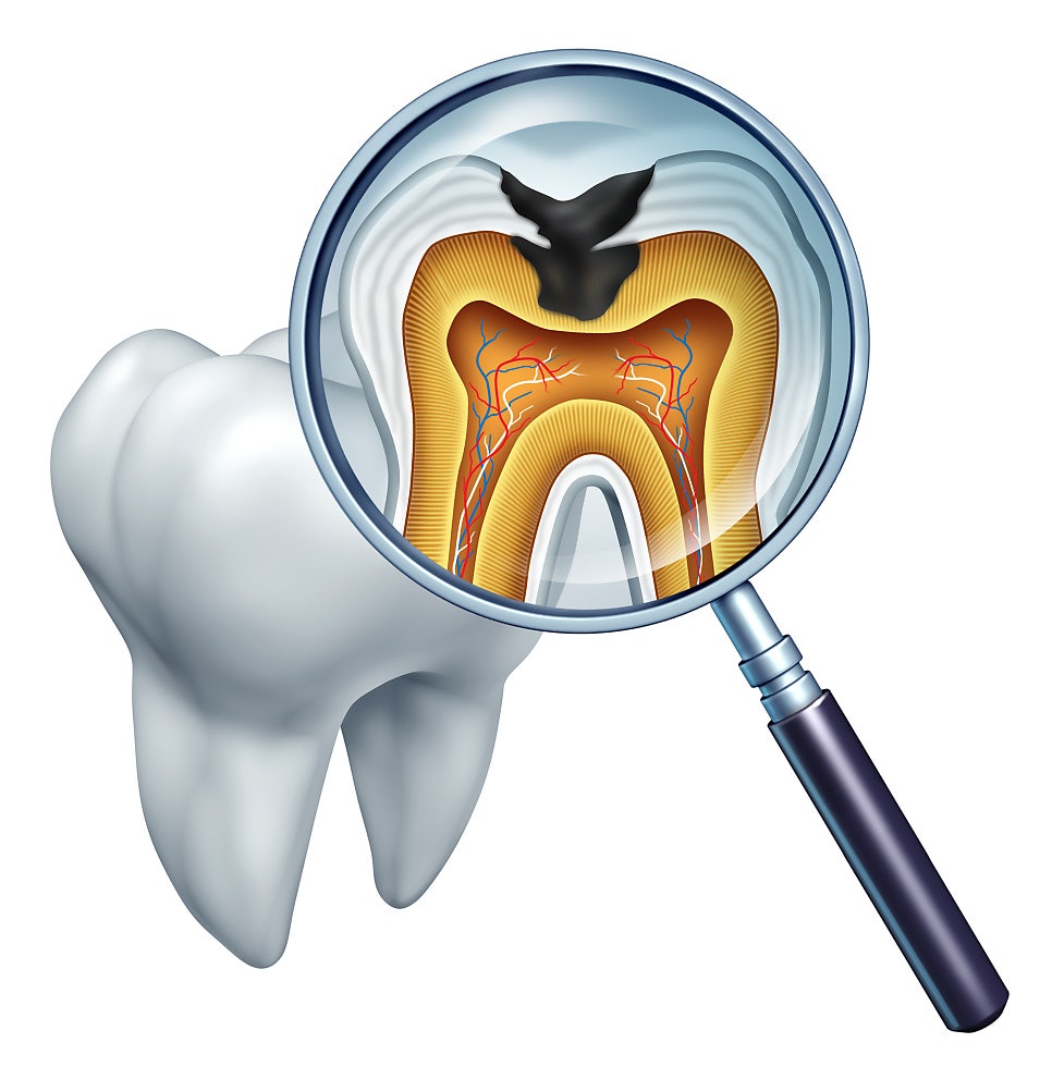 정자동 충치치료