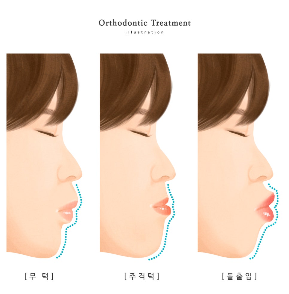 정자동 돌출입교정, 어떻게 달라질까요?