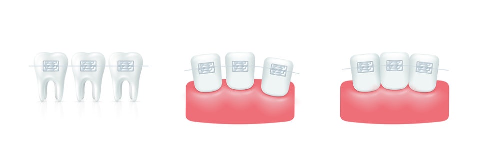정자동 돌출입교정, 어떻게 달라질까요?