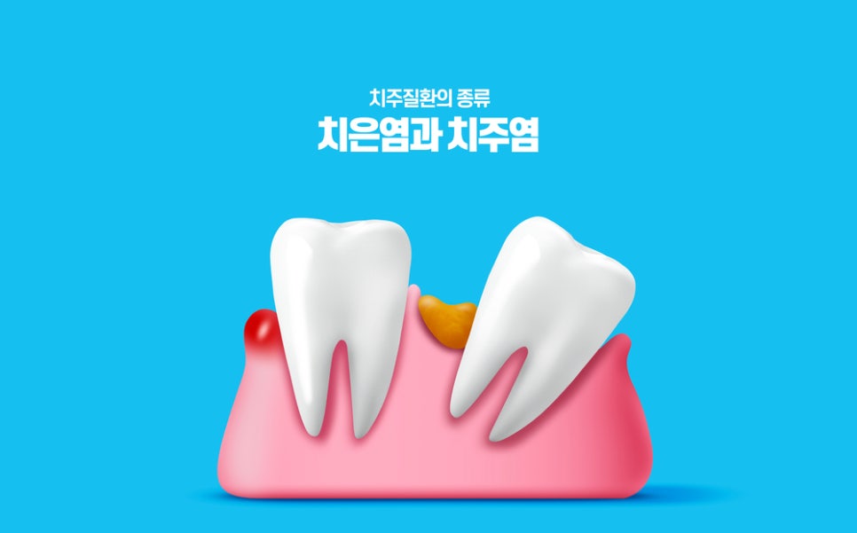 정자동 피 나는 잇몸, 방치하면 임플란트까지?