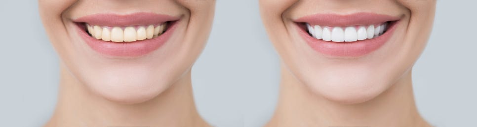 정자역치과, 바쁜 직장인을 위한 원데이 치아 치료는 무엇이 있을까?