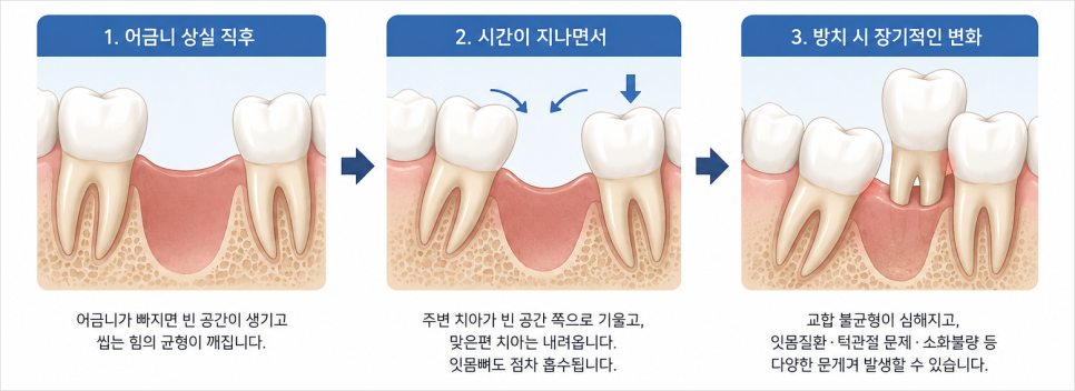 정자동치과 어금니임플란트, 발치한 날 바로 심을 수 있나요?