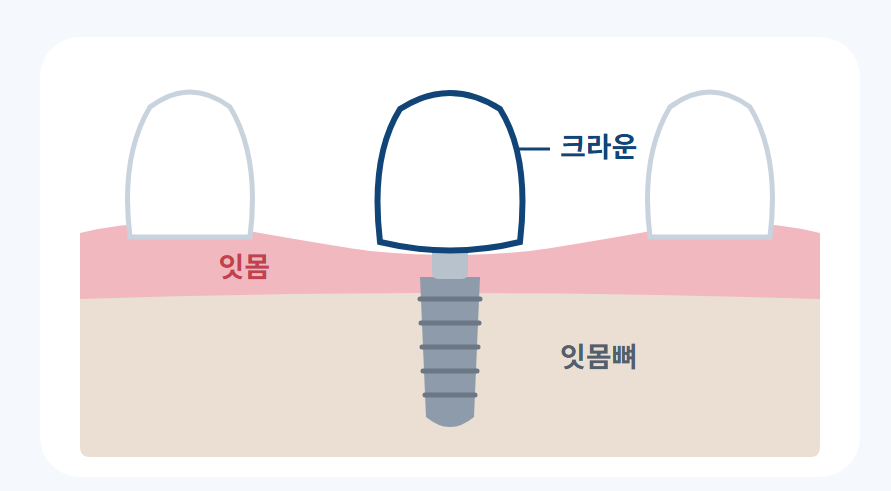 수내치과 임플란트, 10년 넘게 쓰려면 심기 전 잇몸부터 봐야 해요