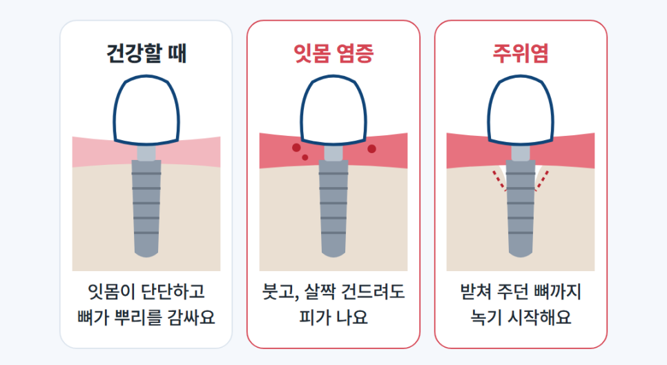 수내치과 임플란트, 10년 넘게 쓰려면 심기 전 잇몸부터 봐야 해요