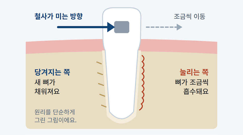수내동치과에서 청소년 치아교정을 받으면 얼마나 걸리나요?