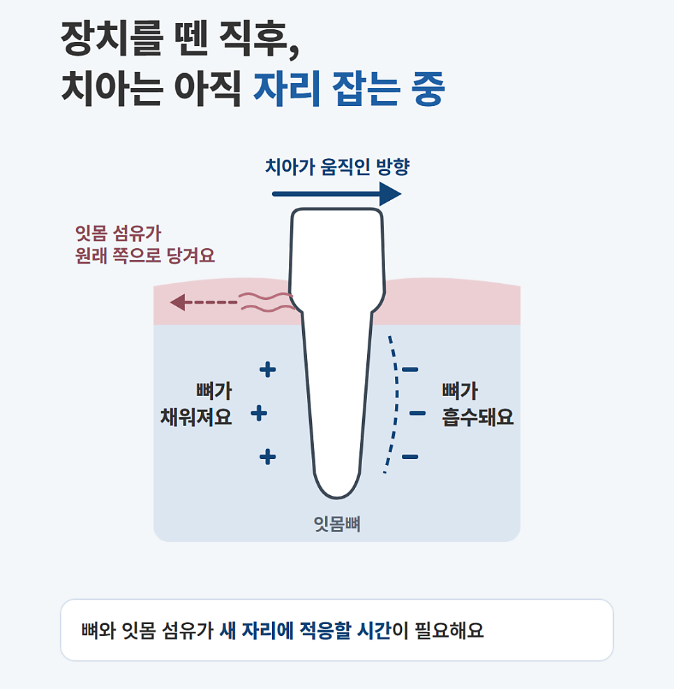 정자동치과, 치아교정이 끝난 뒤 유지장치는 언제까지 껴야 하나요?