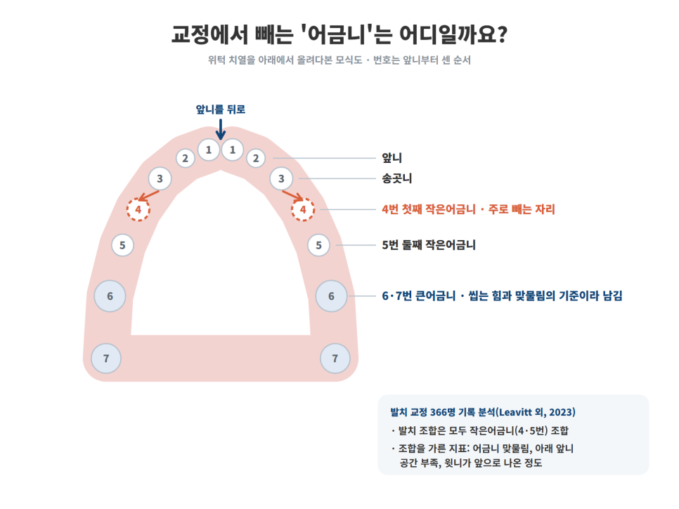 성남치아교정, 교정할 때 어금니를 빼야 하는지는 어떻게 결정되나요?
